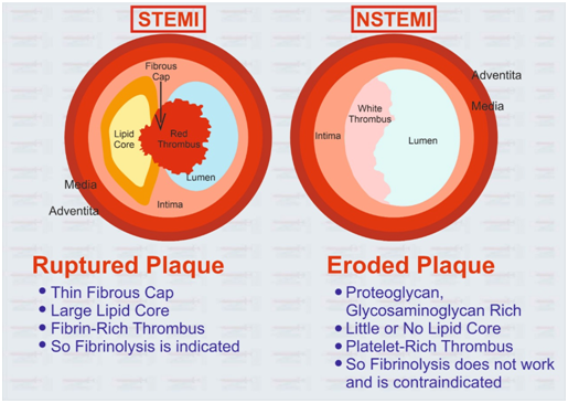 Difference Between Stemi And Nste Acs Dr Deepak Marwah